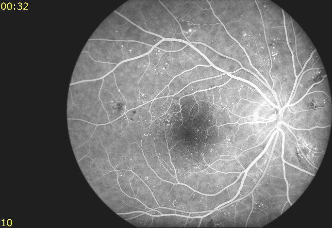 fundus photo f/a