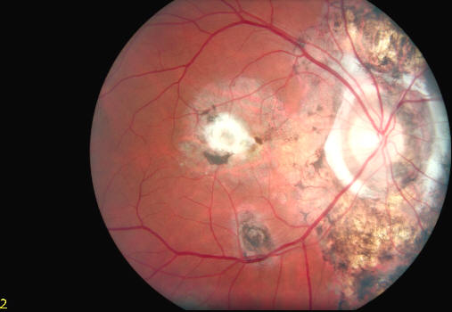 fundus photo color