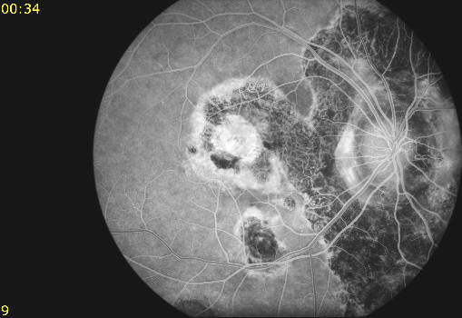 fundus photo f/a