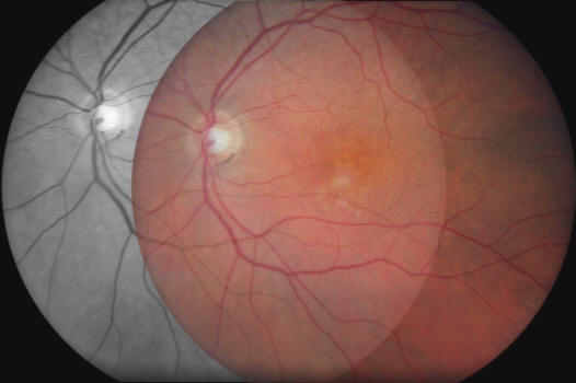 fundus photo overlay